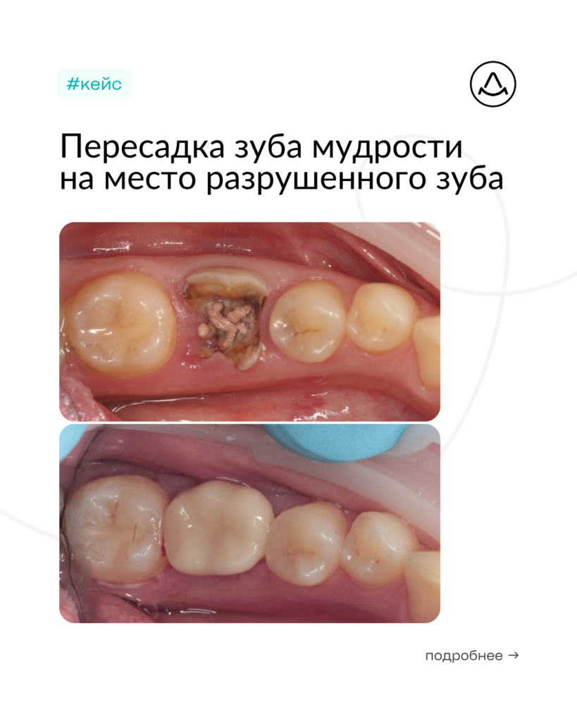 Аутотрансплантация (пересадка) зуба мудрости на место 36 зуба с последующим протезированием, фото 1
