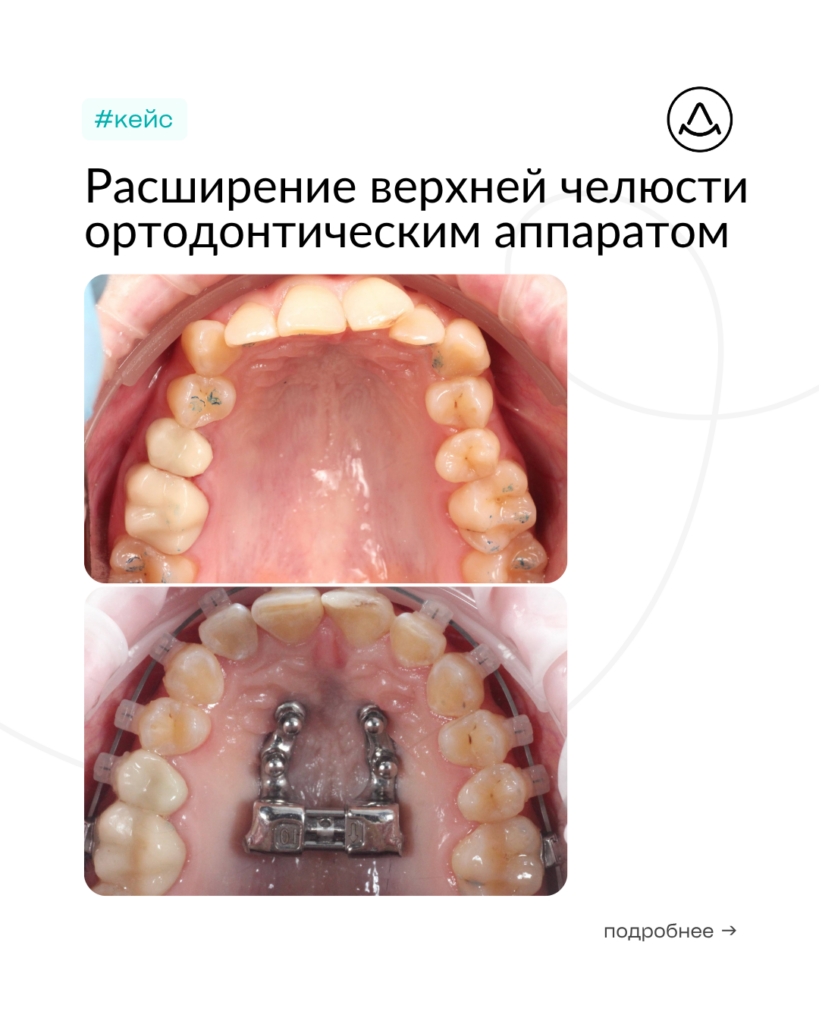 Расширение верхней челюсти ортодонтическим аппаратом MARPE (Марпе) — коррекция прикуса, фото 1