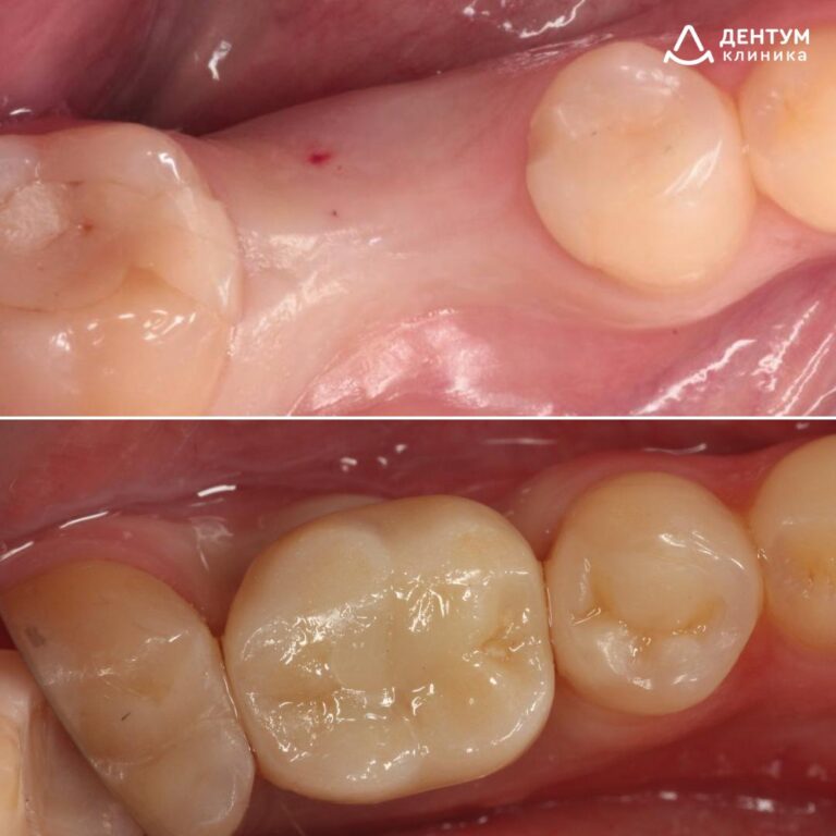 Имплантация Straumann с десневой пластикой и установкой циркониевой коронки
